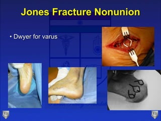 Jones Fracture Nonunion
• Dwyer for varus
 