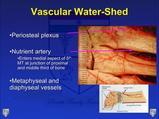 Vascular Water-Shed
•Periosteal plexus
•Nutrient artery
•Enters medial aspect of 5th
MT at junction of proximal
and middle third of bone
•Metaphyseal and
diaphyseal vessels
 