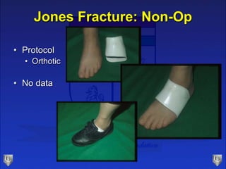 Jones Fracture: Non-Op
• Protocol
• Orthotic
• No data
 