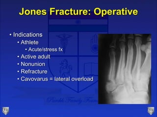 Jones Fracture: Operative
• Indications
• Athlete
• Acute/stress fx
• Active adult
• Nonunion
• Refracture
• Cavovarus = lateral overload
 