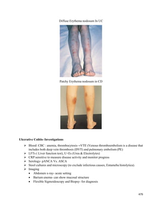 479 
 
Diffuse Erythema nodosum In UC
Patchy Erythema nodosum in CD
Ulcerative Colitis- Investigations
 Blood: CBC : anemia, thrombocytosis→VTE (Venous thromboembolism is a disease that
includes both deep vein thrombosis (DVT) and pulmonary embolism (PE)
 LFTs ( Liver function test), U+Es (Urea & Electrolytes)
 CRP:sensitive to measure disease activity and monitor progress
 Serology- pANCA Vs. ASCA
 Stool cultures and microscopy (to exclude infectious causes; Entameba histolytica).
 Imaging
 Abdomen x-ray- acute setting
 Barium enema- can show mucosal structure
 Flexible Sigmoidoscopy and Biopsy- for diagnosis
 