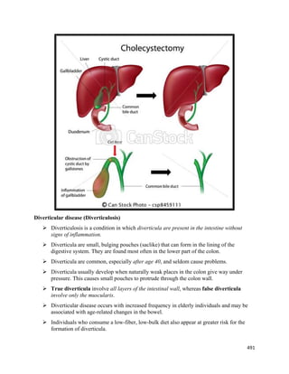 491 
 
Diverticular disease (Diverticulosis)
 Diverticulosis is a condition in which diverticula are present in the intestine without
signs of inflammation.
 Diverticula are small, bulging pouches (saclike) that can form in the lining of the
digestive system. They are found most often in the lower part of the colon.
 Diverticula are common, especially after age 40, and seldom cause problems.
 Diverticula usually develop when naturally weak places in the colon give way under
pressure. This causes small pouches to protrude through the colon wall.
 True diverticula involve all layers of the intestinal wall, whereas false diverticula
involve only the muscularis.
 Diverticular disease occurs with increased frequency in elderly individuals and may be
associated with age-related changes in the bowel.
 Individuals who consume a low-fiber, low-bulk diet also appear at greater risk for the
formation of diverticula.
 