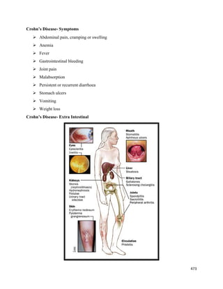 473 
 
Crohn’s Disease- Symptoms
 Abdominal pain, cramping or swelling
 Anemia
 Fever
 Gastrointestinal bleeding
 Joint pain
 Malabsorption
 Persistent or recurrent diarrhoea
 Stomach ulcers
 Vomiting
 Weight loss
Crohn’s Disease- Extra Intestinal
 