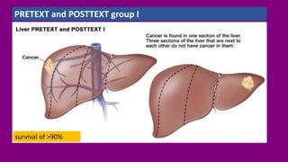 PRETEXT and POSTTEXT group I
survival of >90%
 
