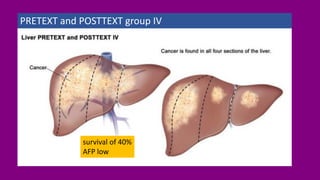 PRETEXT and POSTTEXT group IV
survival of 40%
AFP low
 