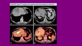 FDG-PET and CT images of a patient with two lesions in the liver.
 