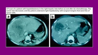 CT scan of a patient with hepatoblastoma in the right hepatic lobe before (a) and after (b) chemotherapy. The
tumor size decreased, and the patient underwent right hepatectomy with surgical margins that were free of
tumor cells.
 