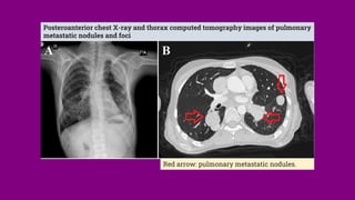 Posteroanterior chest X-ray and thorax computed tomography images of pulmonary
metastatic nodules and foci
Red arrow: pulmonary metastatic nodules.
 