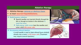 ❖ Percutaneous ethanol injection:
A small needle is used to inject ethanol (pure alcohol)
directly into a tumor to kill cancer cells. (Treatment
may require several injections.)
Ablation therapy
▪ Ablation therapy removes or destroys tissue.
▪ to treat recurrent hepatoblastoma.
❖ Radiofrequency ablation:
❖ Special needles are inserted directly through the
skin or through an incision in the abdomen to
reach the tumor.
❖ High-energy radio waves heat the needles and
tumor which kills cancer cells.
 