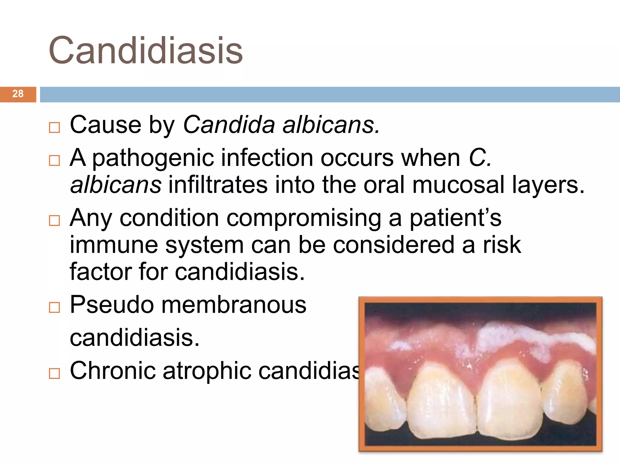 Candidiasis
 Cause by Candida albicans.
 A pathogenic infection occurs when C.
albicans infiltrates into the oral mucosal layers.
 Any condition compromising a patient’s
immune system can be considered a risk
factor for candidiasis.
 Pseudo membranous
candidiasis.
 Chronic atrophic candidiasis
28
 