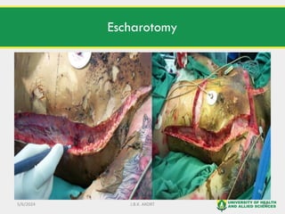 LECTURE 1 BURNS AND SCALDS-SURGICAL NURSING 2.pdf