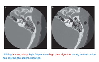 Utilizing a bone, sharp, high frequency or high pass algorithm during reconstruction
can improve the spatial resolution.
 