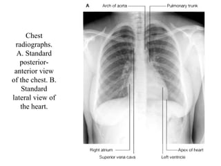 Chest radiographs. A. Standard posterior-anterior view of the chest. B. Standard lateral view of the heart. 