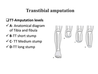 TT-Amputation levels
 A- Anatomical diagram
of Tibia and fibula
 B-TT short stump
 C- TT Medium stump
 D-TT long stump
Transtibial amputation
 