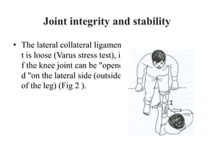 • The lateral collateral ligamen
t is loose (Varus stress test), i
f the knee joint can be "opene
d "on the lateral side (outside
of the leg) (Fig 2 ).
Joint integrity and stability
 