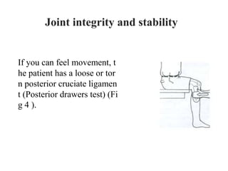 If you can feel movement, t
he patient has a loose or tor
n posterior cruciate ligamen
t (Posterior drawers test) (Fi
g 4 ).
Joint integrity and stability
 