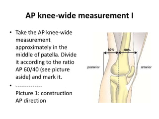 AP knee-wide measurement I
• Take the AP knee-wide
measurement
approximately in the
middle of patella. Divide
it according to the ratio
AP 60/40 (see picture
aside) and mark it.
• --------------
Picture 1: construction
AP direction
 