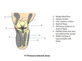 TT Pressure tolerant areas
 