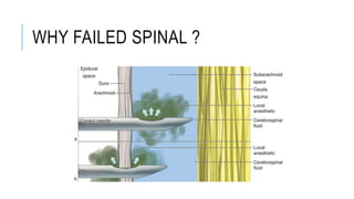WHY FAILED SPINAL ?
 