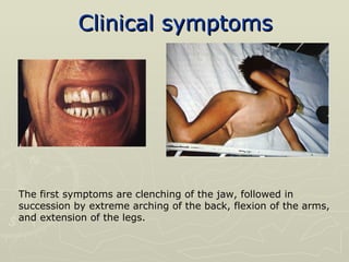 Clinical symptoms The first symptoms are clenching of the jaw, followed in succession by extreme arching of the back, flexion of the arms, and extension of the legs. 