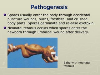 Pathogenesis   Spores usually enter the body through accidental puncture wounds, burns, frostbite, and crushed body parts. Spores germinate and release exotoxin. Neonatal tetanus occurs when spores enter the newborn through umbilical wound after delivery.  Baby with neonatal tetanus 