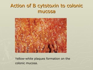 Action of B cytotoxin to colonic mucosa Yellow-white plaques formation on the  colonic mucosa.  