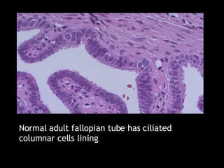 Normal adult fallopian tube has ciliated columnar cells lining   