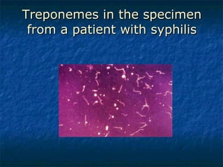 Treponemes in the specimen from a patient with syphilis 