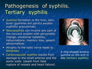 Pathogenesis  of syphilis. Tertiary  syphilis Gumma  formation in the liver, skin, bone (gummas are painful swollen syphilitic granulomas) Neurosyphilis  can involve any part of the nervous system with personality change, emotional instability, hallucinations, memory loss, speech abnormalities Atrophy fo the optic verve leads to  blindness Cardiovascular syphilis  results from damage to the small arteries and the aortic walls  (death from fatal rupture of vessels and heart failure) A ring-shaped erosive gumma on the arm in late  (tertiary syphilis) 