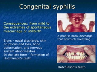 Congenital syphilis A profuse nasal discharge that obstructs breathing Hutchinson's teeth Consequences: from mild to the extremes of spontaneous miscarriage or stillbirth Signs - nasal discharge ,  skin eruptions and loss, bone deformation, and nervous system abnormalities.  In the late form - formation of Hutchinson's teeth 