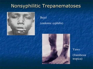 Nonsyphilitic Trepanematoses Yaws  (frambesia tropica) Bejel  (endemic syphilis) 