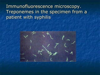 Immunofluorescence microscopy. Treponemes in the specimen from a patient with syphilis 