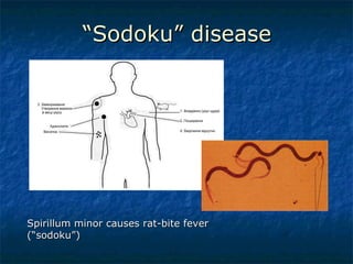 “ Sodoku” disease Spirillum minor causes rat-bite fever (“sodoku”) 