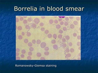 Borrelia in blood smear Romanowsky-Giemsa staining  