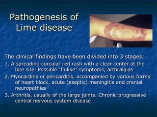 Pathogenesis of Lime disease The clinical findings have been divided into 3 stages: 1. A spreading curcular red rash with a clear center at the bite site. Possible “flulike” symptoms, arthralgias 2. Myocarditis or pericarditis, accompanied by various forms of heart block, acute (aseptic) meningitis and cranial neuropathies  3. Arthritis, usually of the large joints. Chronic progressive central nervous system disease 