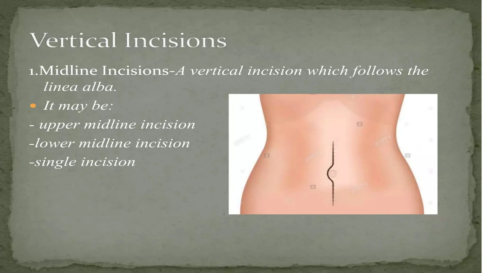 T Incision Classical LECTURE 23 May 2023 SURGICAL APPROACH, INCISIONS.pptx
