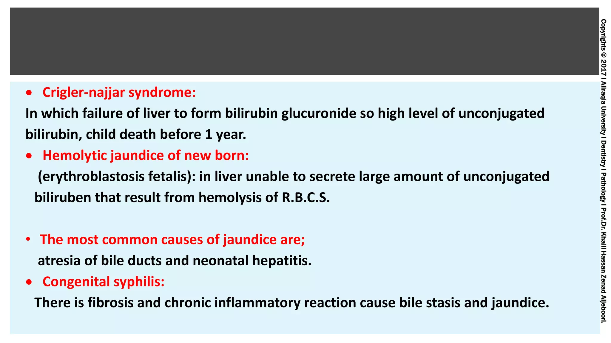 Copyrights©2017lAliraqiaUniversitylDentistrylPathologylProf.Dr.KhalilHassanZenadAljeboori.
 Crigler-najjar syndrome:
In which failure of liver to form bilirubin glucuronide so high level of unconjugated
bilirubin, child death before 1 year.
 Hemolytic jaundice of new born:
(erythroblastosis fetalis): in liver unable to secrete large amount of unconjugated
biliruben that result from hemolysis of R.B.C.S.
• The most common causes of jaundice are;
atresia of bile ducts and neonatal hepatitis.
 Congenital syphilis:
There is fibrosis and chronic inflammatory reaction cause bile stasis and jaundice.
 