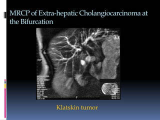 MRCP of Extra-hepatic Cholangiocarcinoma at
the Bifurcation
Klatskin tumor
 