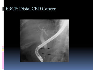 ERCP: Distal CBD Cancer
 