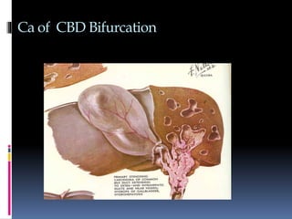 Ca of CBD Bifurcation
 