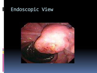 Endoscopic View
 