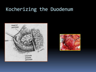 Kocherizing the Duodenum
 