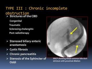 TYPE III : Chronic incomplete
obstruction
 Strictures of the CBD
Congenital
Traumatic
Sclerosing cholangitis
Post radiotherapy
 Stenosed biliary enteric
anastamosis
 Cystic fibrosis
 Chronic pancreatitis
 Stenosis of the Sphincter of
Oddi
ERCP showing distal common bile duct
stricture with proximal dilation
 
