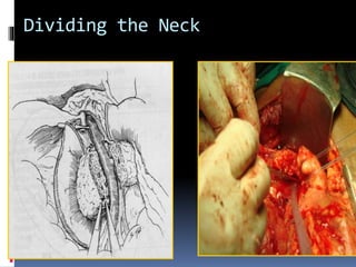 Dividing the Neck
 