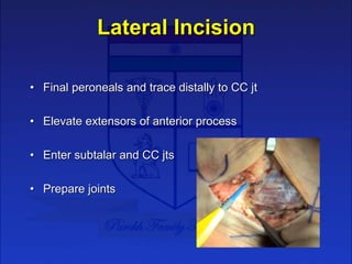 Lateral Incision
• Final peroneals and trace distally to CC jt
• Elevate extensors of anterior process
• Enter subtalar an...