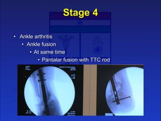 Stage 4
• Ankle arthritis
• Ankle fusion
• At same time
• Pantalar fusion with TTC rod
 