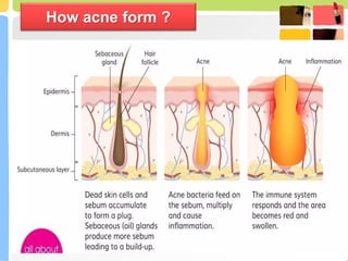 Comprehensive Overview of Acne: Causes, Types, and Treatments | PPTX