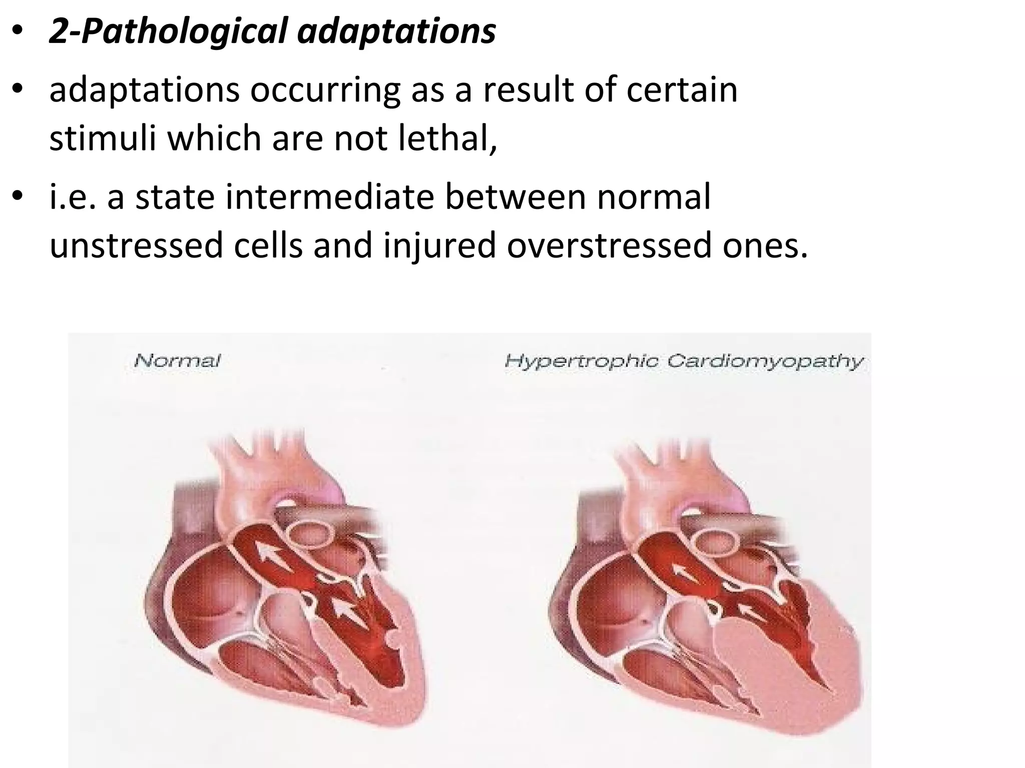 • 2-Pathological adaptations
• adaptations occurring as a result of certain
stimuli which are not lethal,
• i.e. a state intermediate between normal
unstressed cells and injured overstressed ones.
 