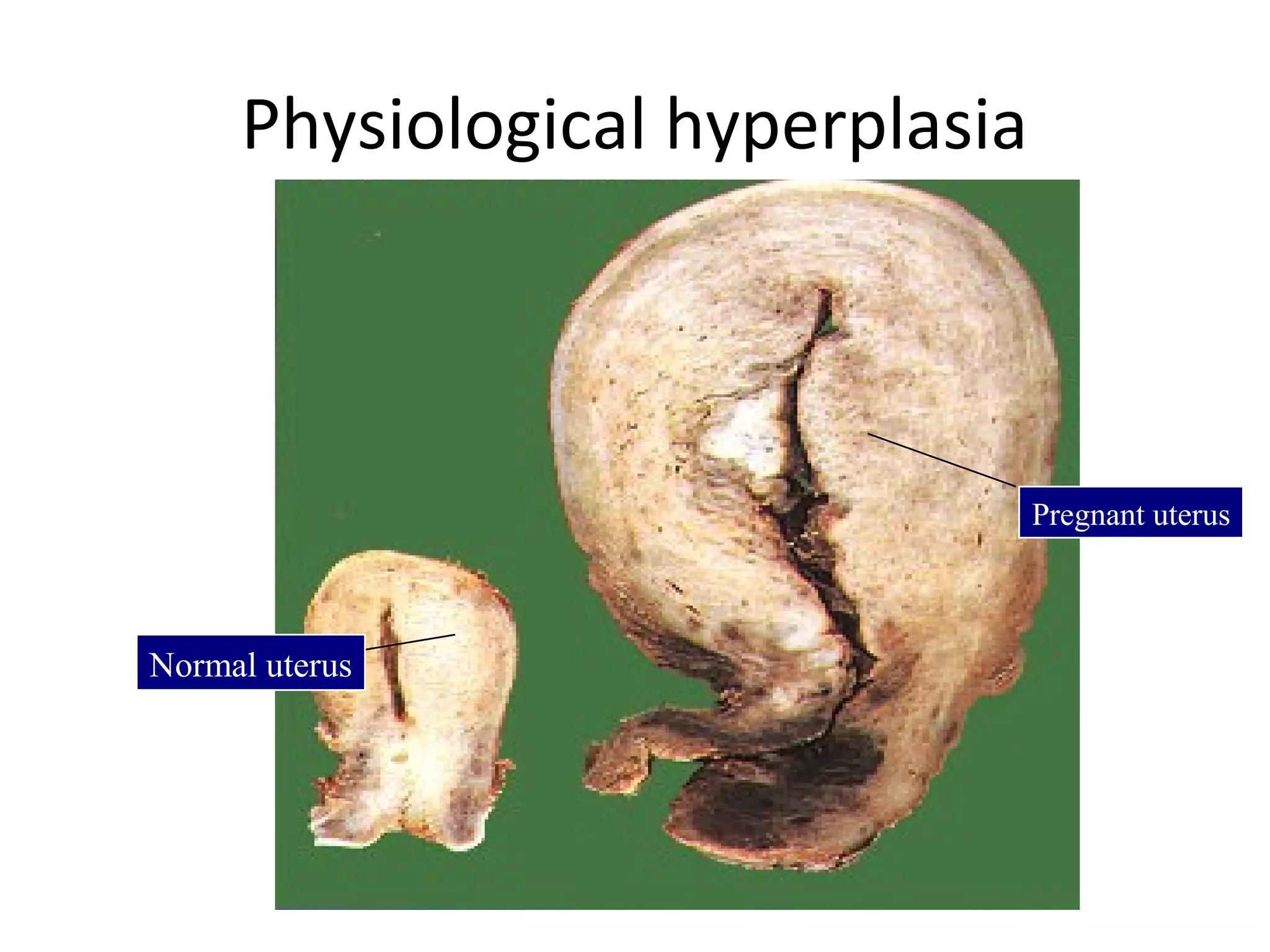 Physiological hyperplasia
Normal uterus
Pregnant uterus
 