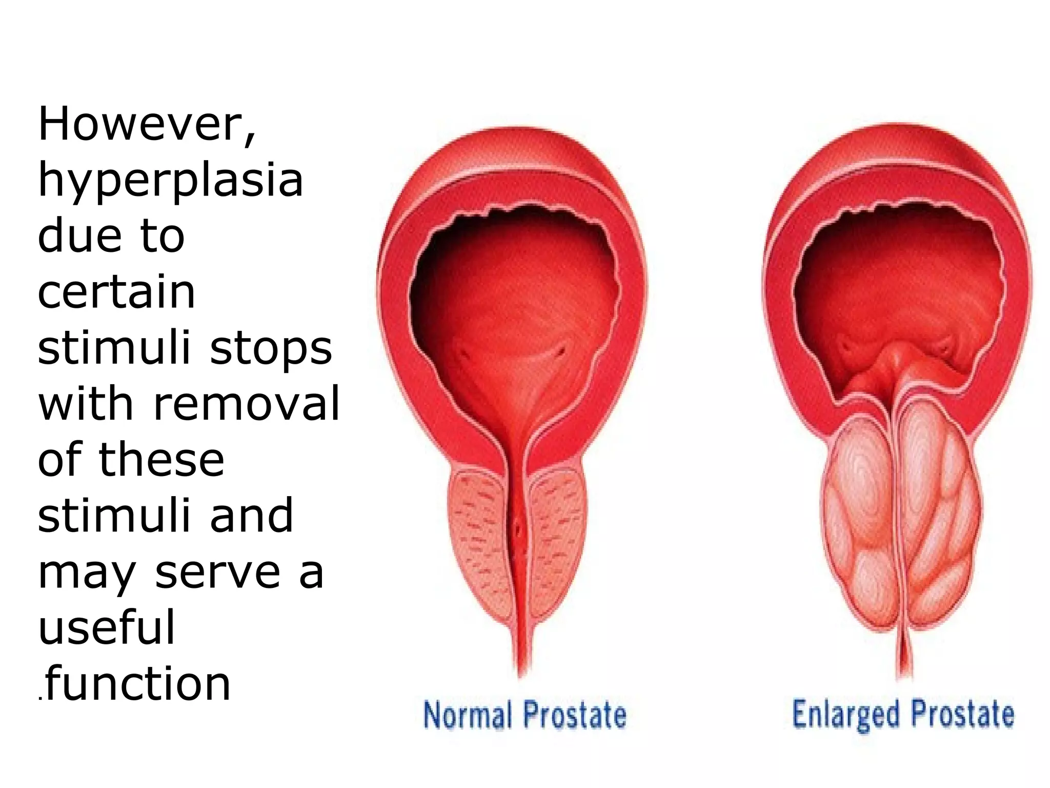 However,
hyperplasia
due to
certain
stimuli stops
with removal
of these
stimuli and
may serve a
useful
function.
 